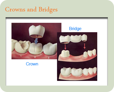 Crowns & Bridges - Dental Crown and Bridge tooth replacement